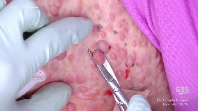 Illustration for article titled Dr. Pimple Popper, Now With Fart Jokes
